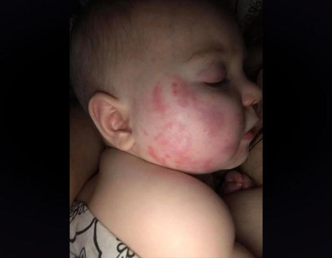 Kreşe bıraktığı bebeğini ısırık izleri i&ccedil;inde buldu! Kameraları izleyince şoke oldu