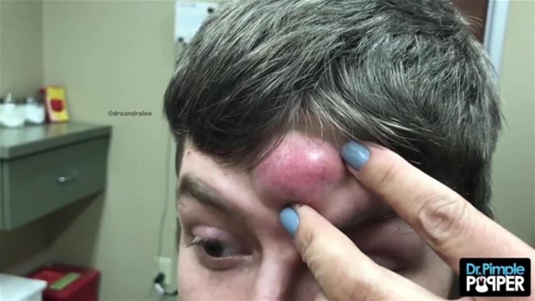 Alnındaki kist kesilince...