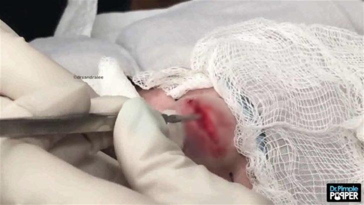 Alnındaki kist kesilince... G2