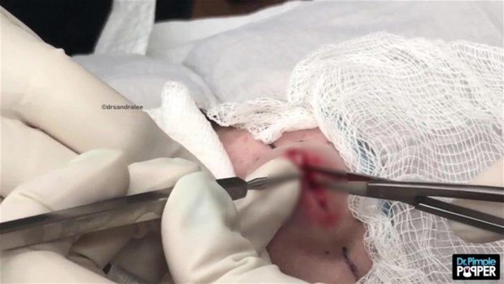 Alnındaki kist kesilince... G3