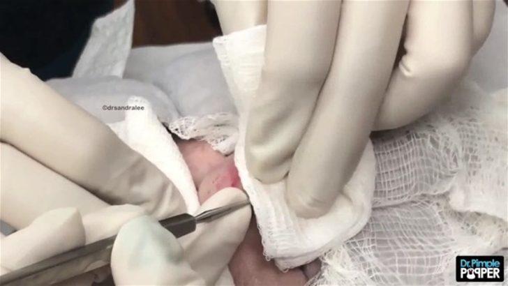 Alnındaki kist kesilince... G4