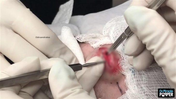 Alnındaki kist kesilince... G5