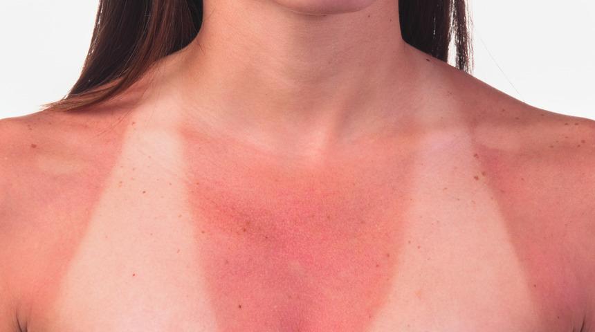 Güneş yanığı tedavisi / Güneş yanığı nasıl geçer?