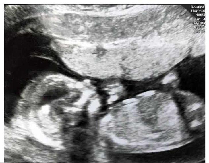 Yirmi çocuk annesi kadın 21. çocuğuna hamile  G2