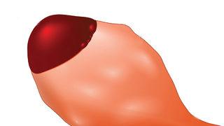 Çikolata kistlerinin tedavisi var mıdır?