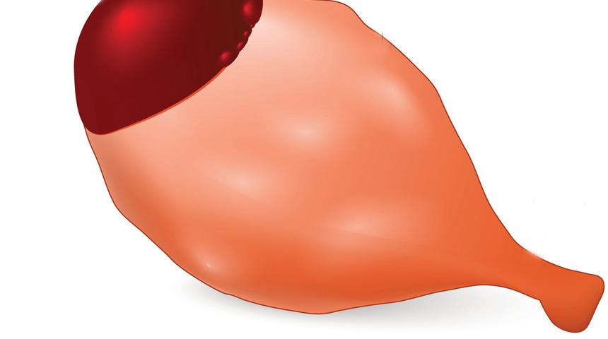 Çikolata kistlerinin tedavisi var mıdır?