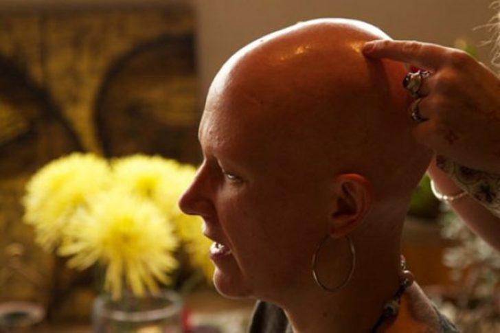 Kaybettiği saçlarının yerine bakın ne yaptırdı  G2