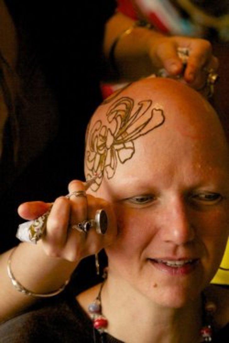 Kaybettiği saçlarının yerine bakın ne yaptırdı  G3