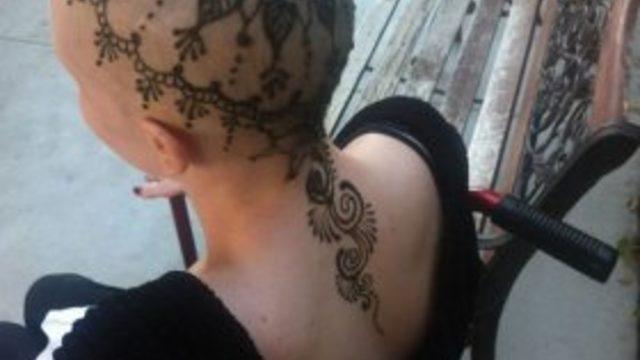 Kaybettiği saçlarının yerine bakın ne yaptırdı 