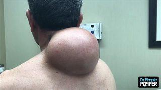 Boynunda kocaman kist vardı 