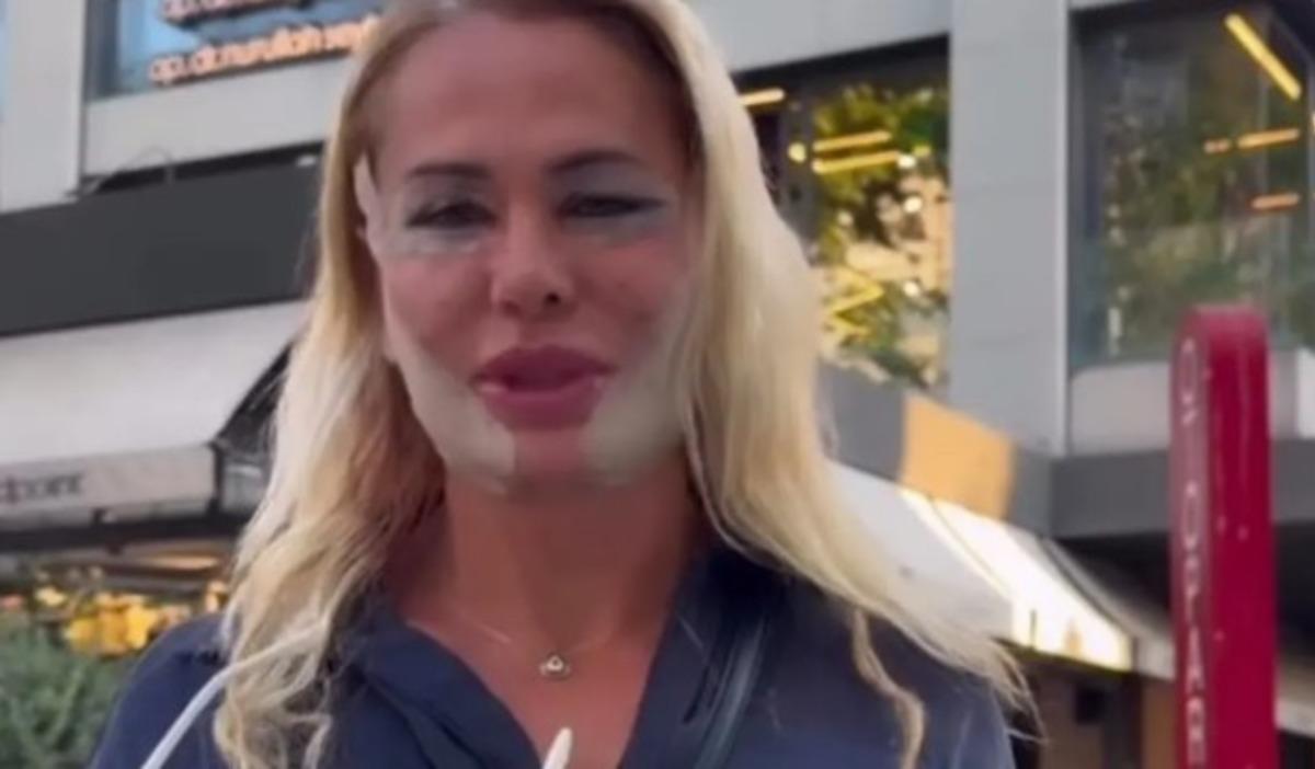 Survivor 2026 ikincisi Nagihan Karadere estetik yaptırdı! Son hali gündem oldu 2
