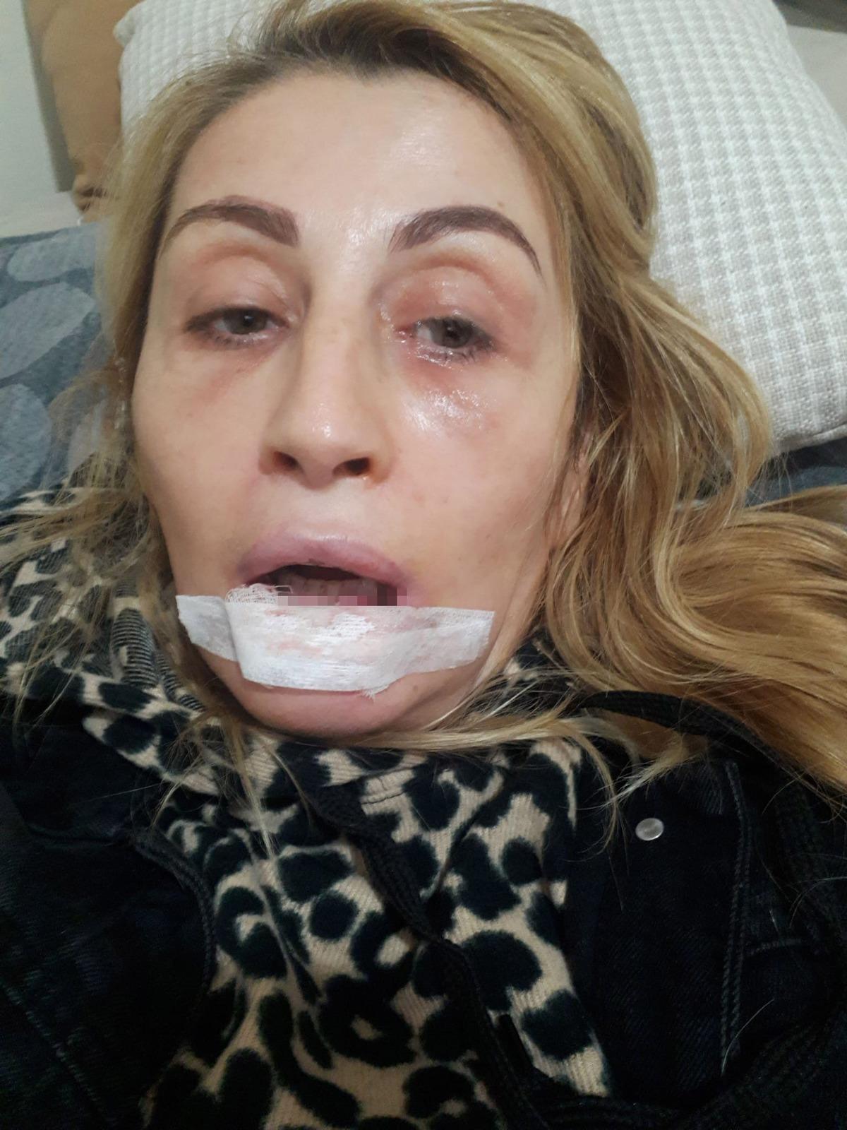 Göbeğinden alıp yüzüne enjekte ettiler: Dudağını çürüttü! 3