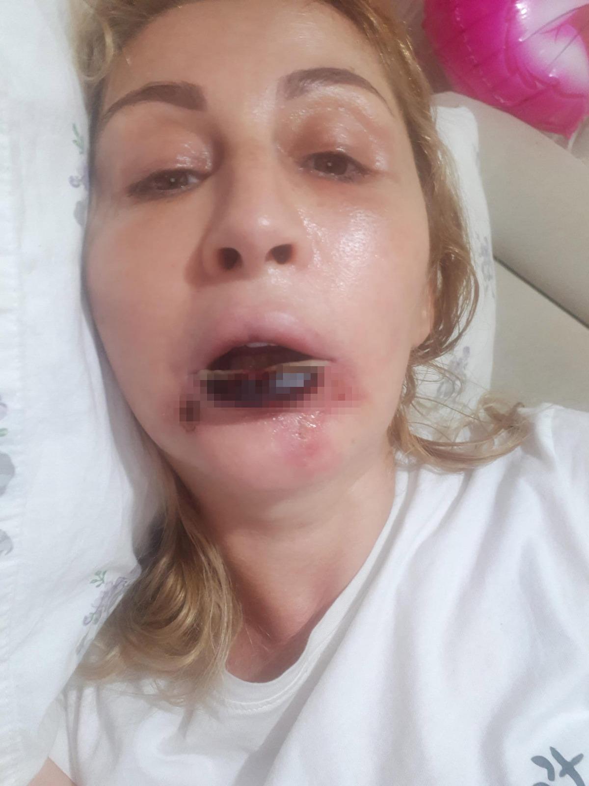 Göbeğinden alıp yüzüne enjekte ettiler: Dudağını çürüttü! 4