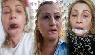 G&ouml;beğinden alıp y&uuml;z&uuml;ne enjekte ettiler: Dudağını &ccedil;&uuml;r&uuml;tt&uuml;! 