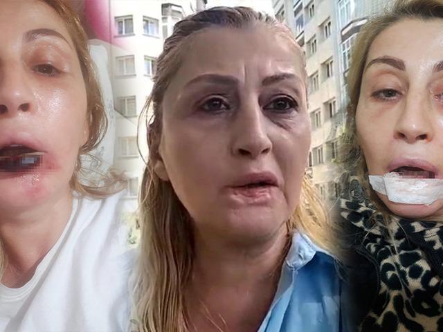 G&ouml;beğinden alıp y&uuml;z&uuml;ne enjekte ettiler: Dudağını &ccedil;&uuml;r&uuml;tt&uuml;! 