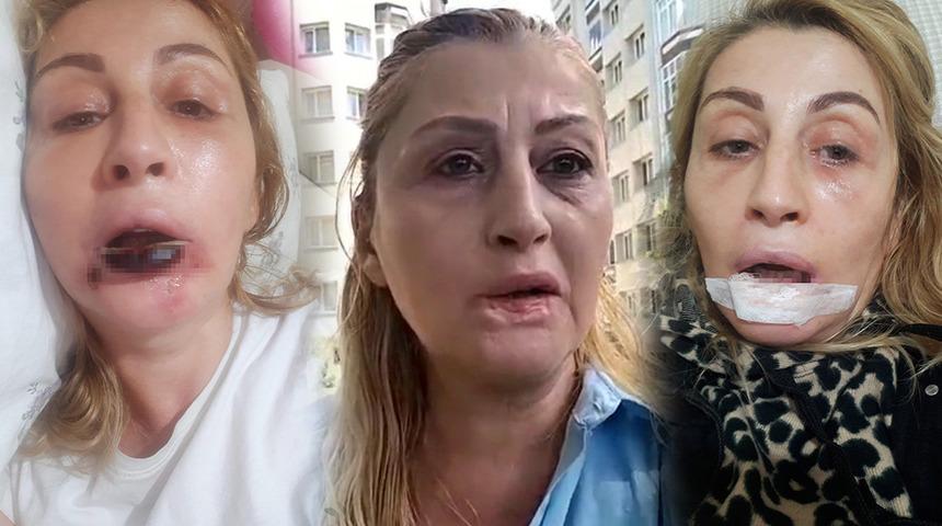 G&ouml;beğinden alıp y&uuml;z&uuml;ne enjekte ettiler: Dudağını &ccedil;&uuml;r&uuml;tt&uuml;! 