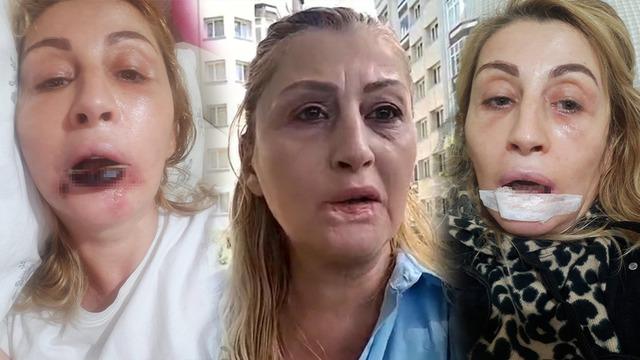 Göbeğinden alıp yüzüne enjekte ettiler: Dudağını çürüttü! 