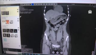 Doktorlar inanamadı: Zayıflamak isterken diş fır&ccedil;ası yuttu