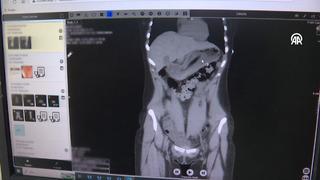 Doktorlar inanamadı: Zayıflamak isterken diş fırçası yuttu