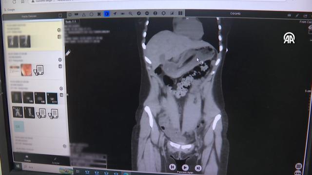Doktorlar inanamadı: Zayıflamak isterken diş fırçası yuttu