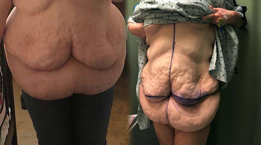 Hayalini kurduğu v&uuml;cuda 51 bin TL &ouml;dedi! Sarkan derileri g&uuml;ndem oldu