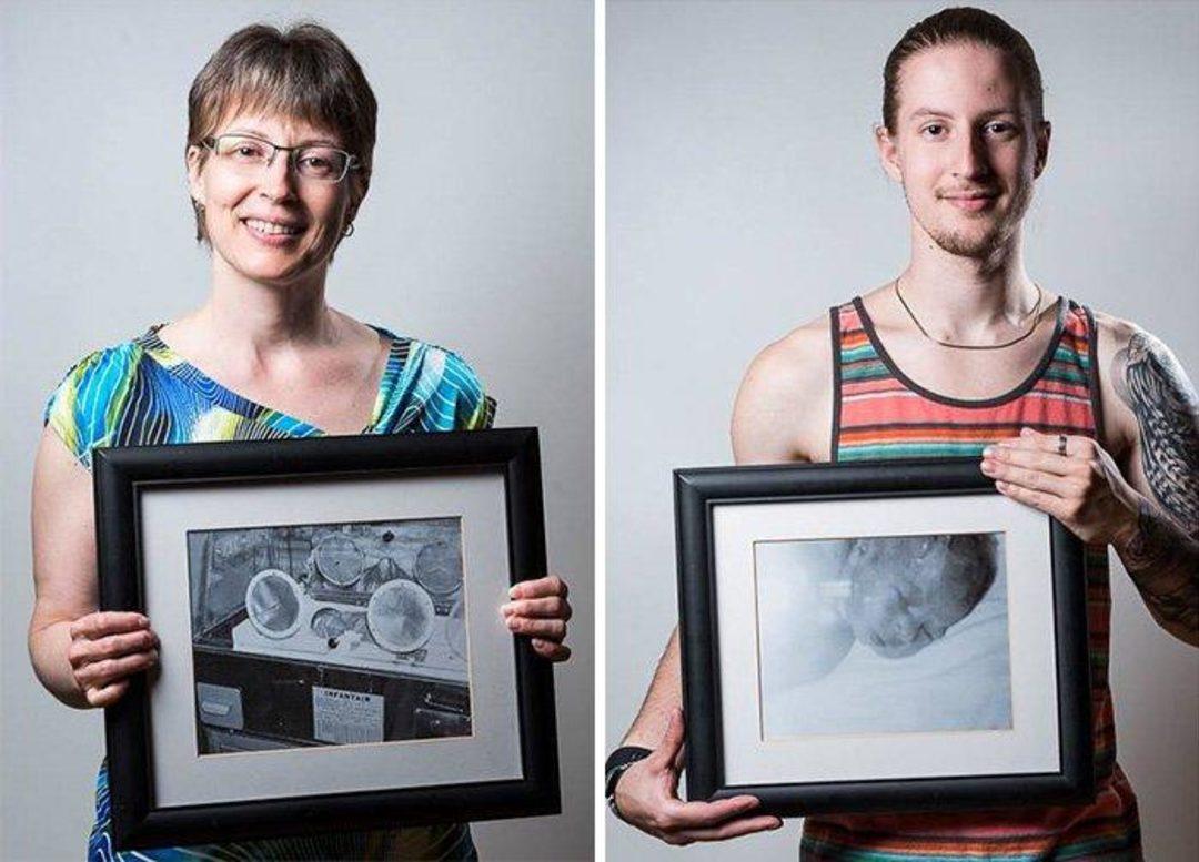 недоношенные дети до и после фотографий