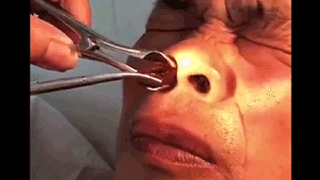 Burnundan &ccedil;ıkanı g&ouml;renler g&ouml;zlerine inanamadı!