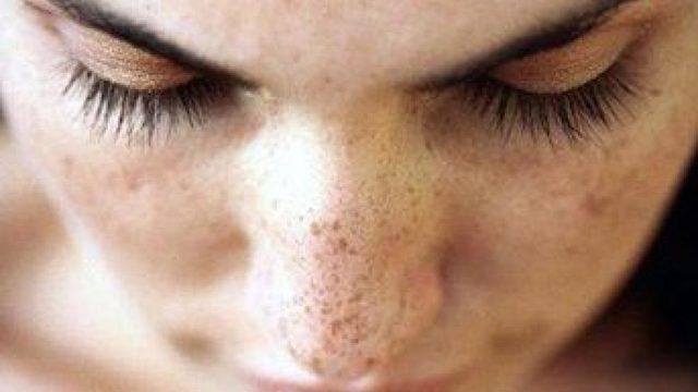 Güneşle gelen cilt lekelerine dikkat!