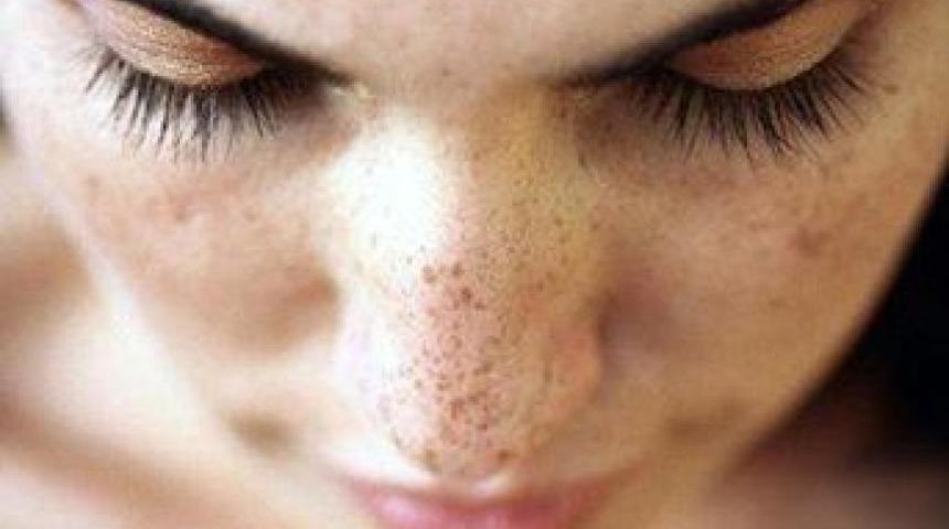 Güneşle gelen cilt lekelerine dikkat!