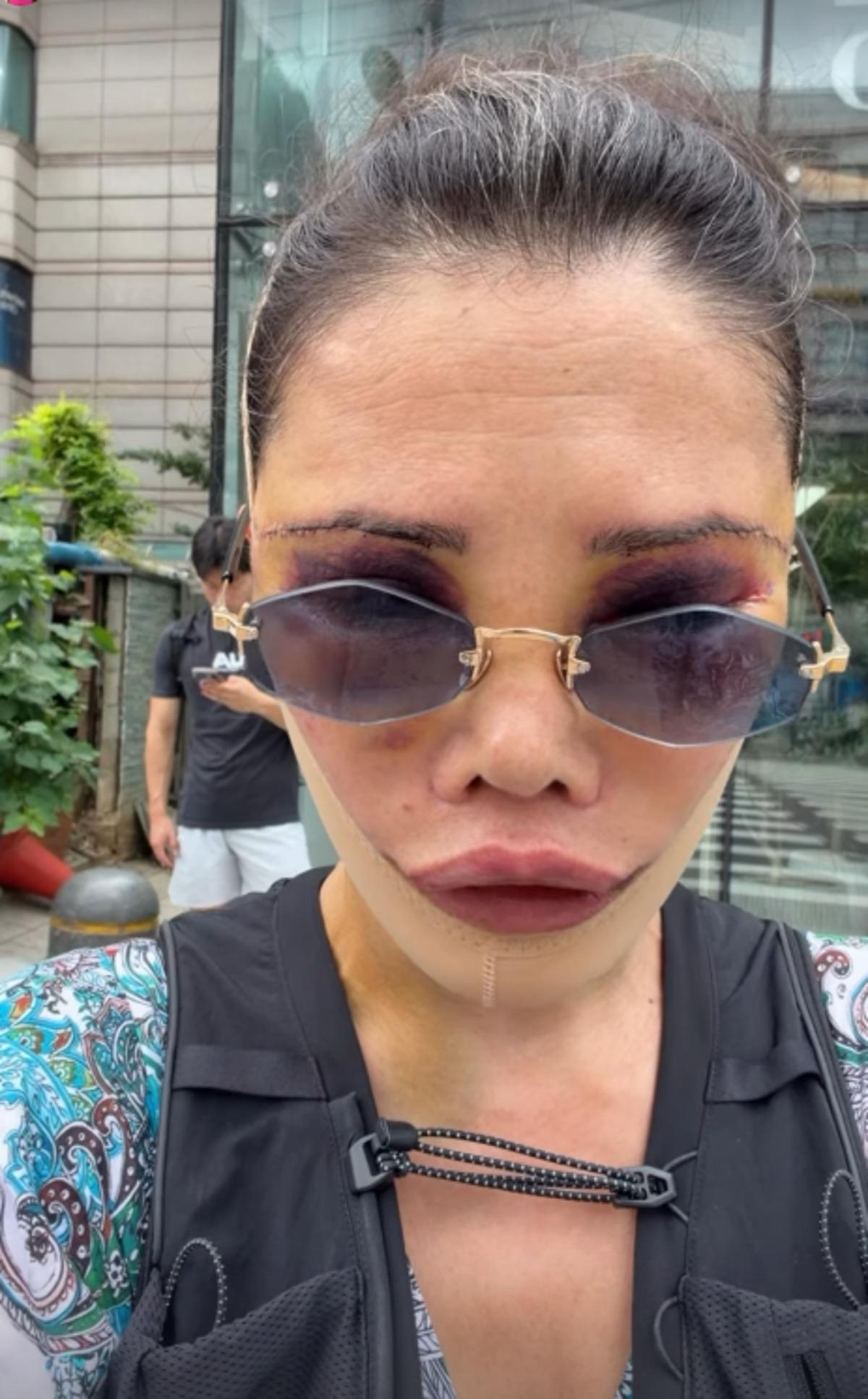 Yüz naklinin ardından revizyon ameliyatı olmuştu! Didem Ceran son haliyle yine gündemde 3
