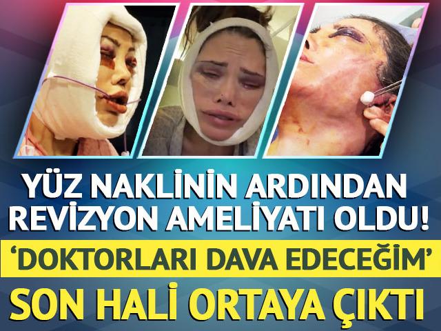 Y&uuml;z naklinin ardından revizyon ameliyatı olmuştu! Didem Ceran son haliyle yine g&uuml;ndemde