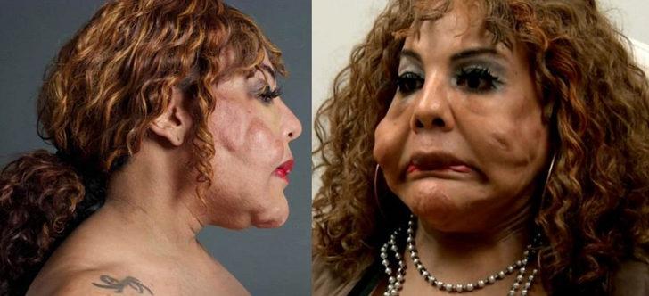 Estetik faciası! Y&uuml;z&uuml;ne &ccedil;imento enjekte edildi, tanınmaz hale geldi