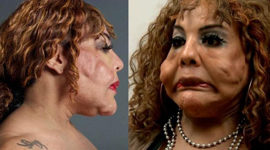 Estetik faciası! Y&uuml;z&uuml;ne &ccedil;imento enjekte edildi, tanınmaz hale geldi