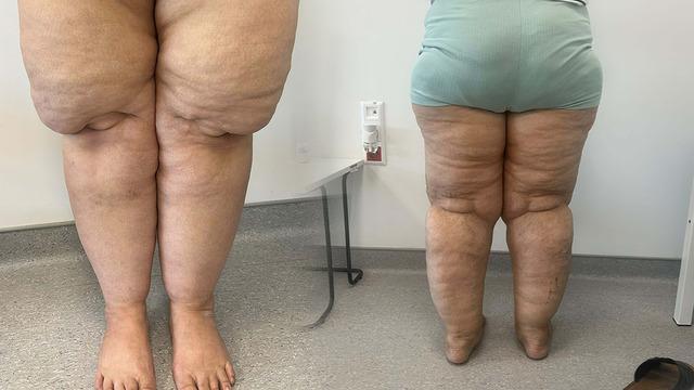 Herkes kilo problemi olarak görüyor: Lipodem nedir? 