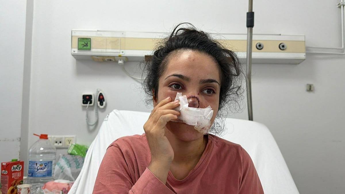 Eşinin burnunu ısırıp koparttı! Acıyla balkon atlayacaktı 1