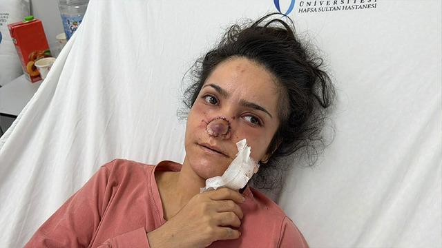 Eşinin burnunu ısırıp koparttı! Acıyla balkon atlayacaktı