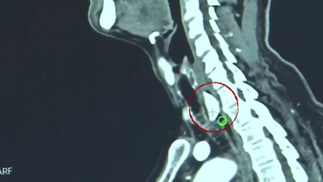 Boğazından 4 santimlik kemik çıktı! Herkesi şok etti