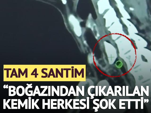 Boğazından 4 santimlik kemik &ccedil;ıktı! "Herkesi şok etti"