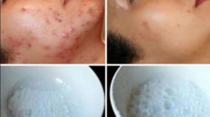 Yüz lekelerini ikinci kullanımda yok eden maske