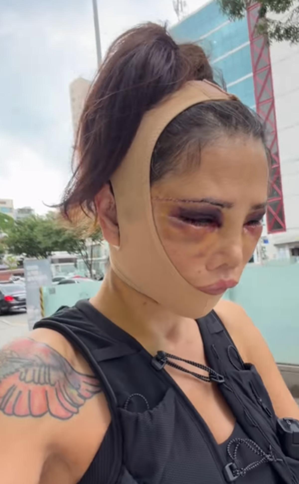 Yüz naklinin ardından revizyon ameliyatı olmuştu! Didem Ceran son haliyle korkuttu 2