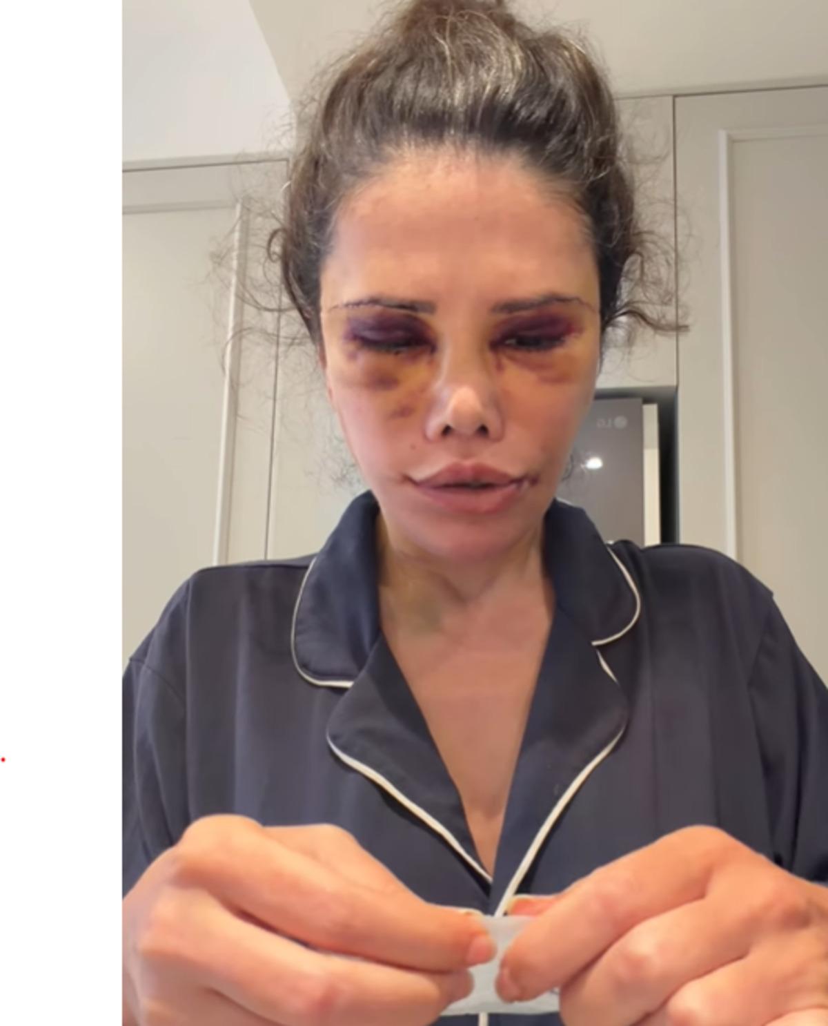 Yüz naklinin ardından revizyon ameliyatı olmuştu! Didem Ceran son haliyle korkuttu 1