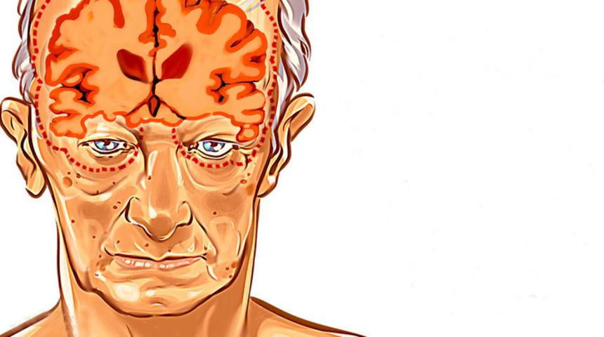 Alzheımer'ın belirtileri 20 yıl önce başlıyor! Bu önerileri dikkate alın 