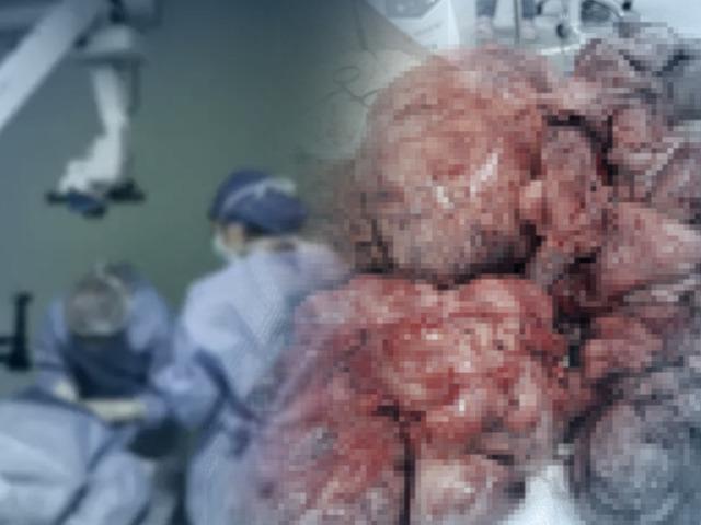 Literat&uuml;re ge&ccedil;ti: Rahminden 17 kilo miyom &ccedil;ıkarıldı! D&uuml;nyada bir ilk