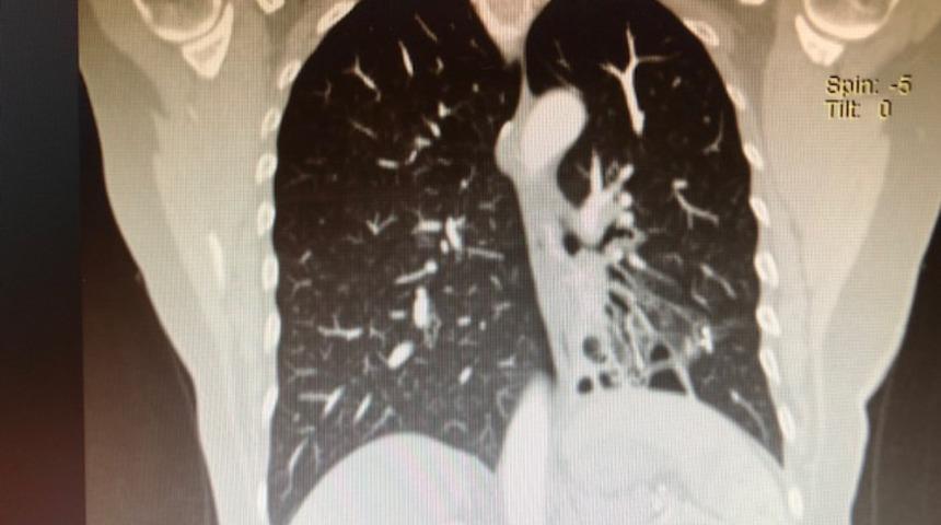 Eğer geçmeyen öksürükten şikayet ediyorsanız siz de bronşektazi hastası olabilirsiniz