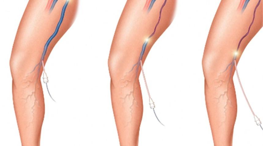 Öğle arasında varis ameliyatı