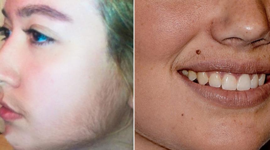  Yüz tüylerinden kurtulmanın 9 doğal yolu