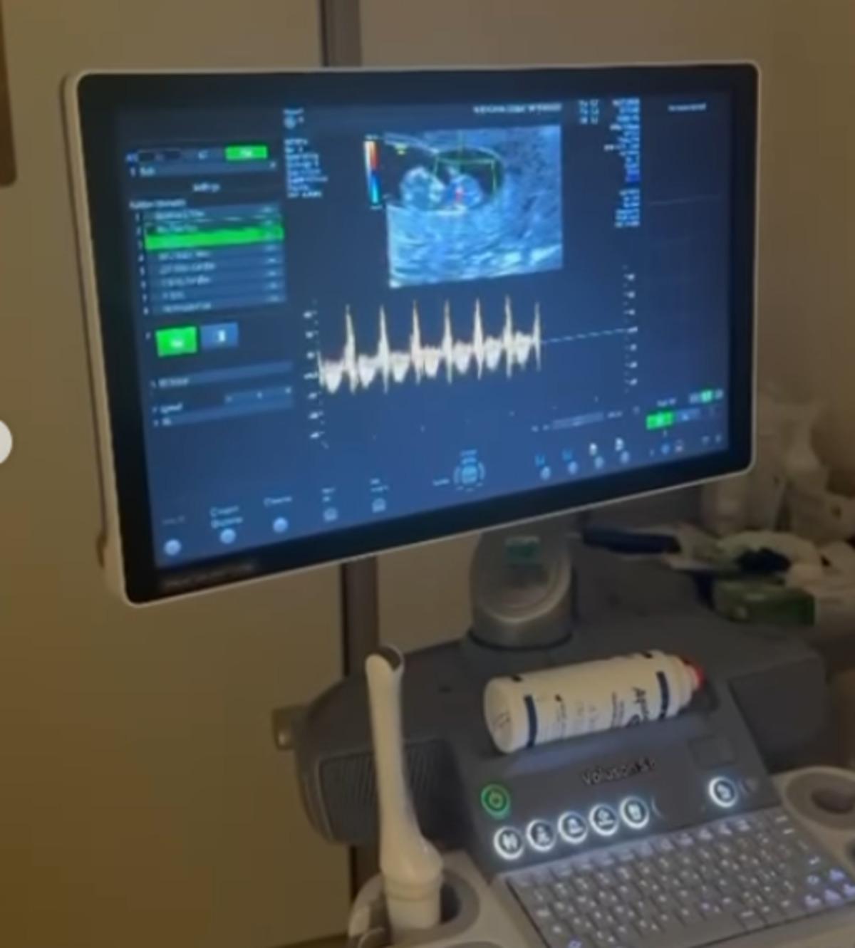 Berfu Yenenler kaybettiği bebeğinin ultrason görüntülerini paylaştı 2