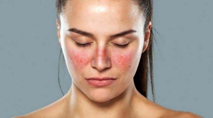 Lupus hastalığı nedir, belirtileri nelerdir?