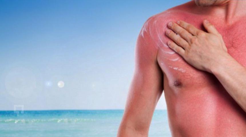 Yoğurdun cilt yanığına faydası var mı?