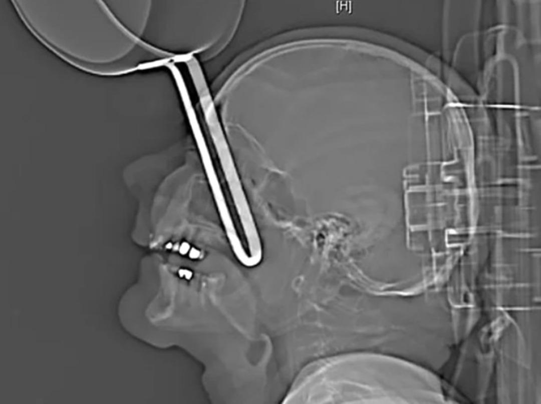 Akılalmaz olay! Mutfakta yere d&uuml;şt&uuml;, g&ouml;z&uuml;ne tencere saplandı